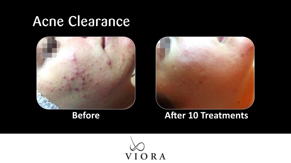 Acne Clearance Before and After 1