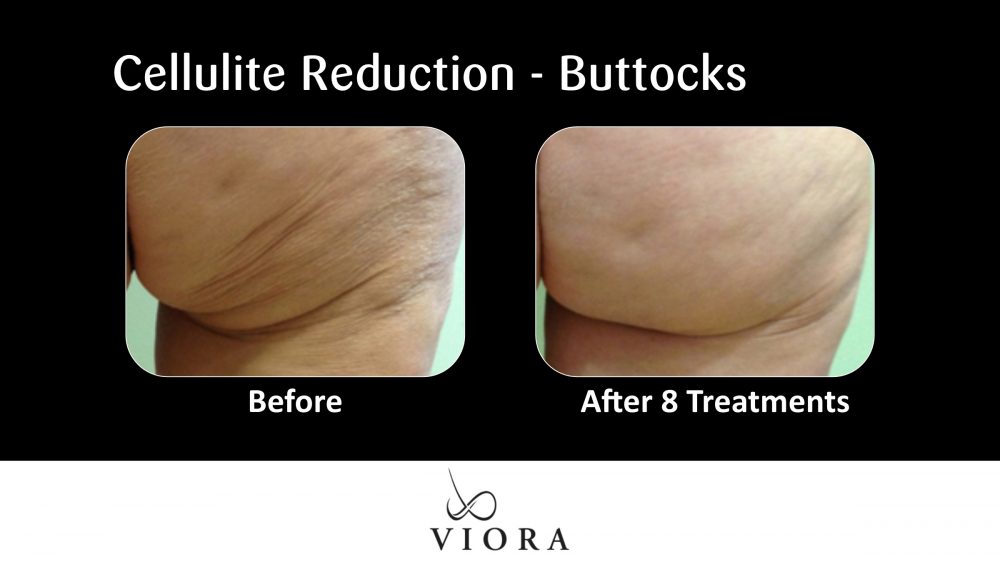 Cellulite Reduction Buttocks Before and After 5