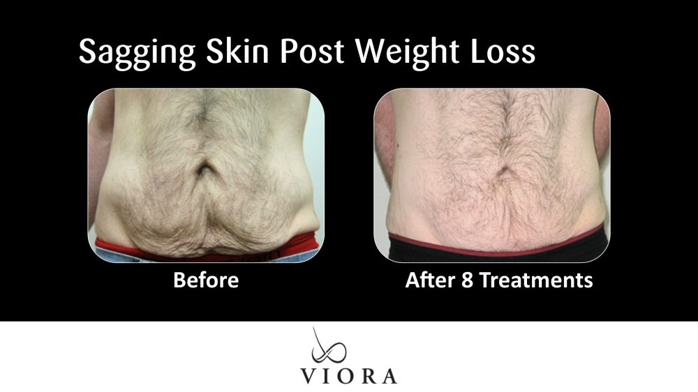 Sagging Skin Post Weight Loss Before and After